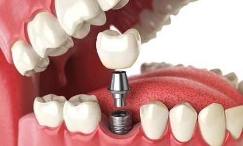 2. Implanti dentali è cumu implementà